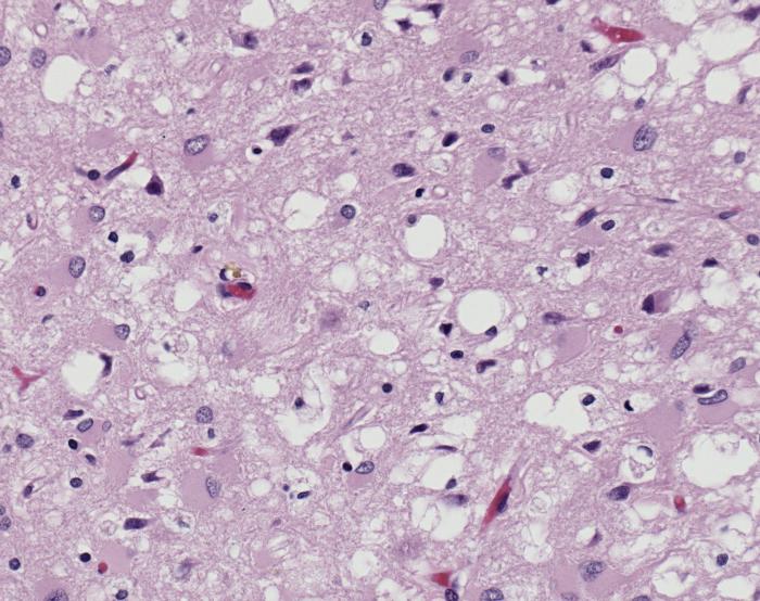 Pink-stained brain tissue, magnified, riddled with small round white holes among scattered dark cell nuclei