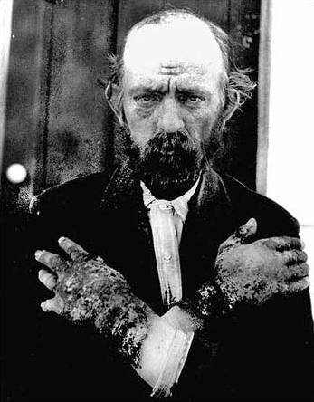 A black-and-white photograph of a bearded man in a dark coat, his arms folded across his chest so that the backs of both hands face the camera. The skin on his hands and forearms is thickened, cracked and scaled from the knuckles to above the wrist